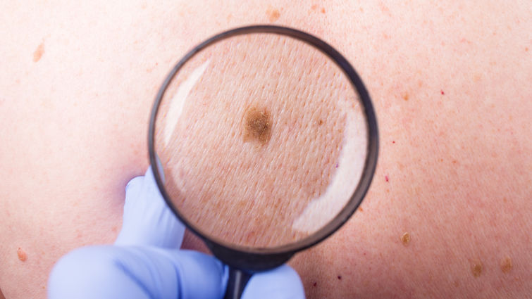 Five Little Known Things About Skin Cancer Lluh News Five Little Known Things About Skin Cancer Lluh News