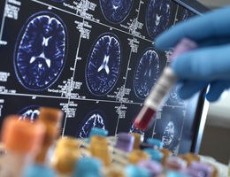 Scientist holding a blood sample during a clinical trial with a MRI on screen - stock photo