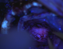 This photo shows the fluorescent features in gliomas under blue light of fluorescent-guided neurosurgery in a procedure performed by Dr. Tarek El Ahmadieh.