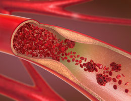 The ABC’s of coronary artery disease