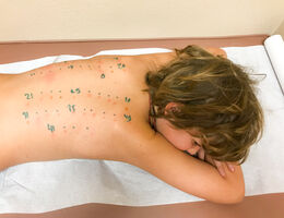 Child lays in a doctor's office while getting tested for allergies on his back.