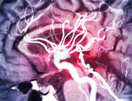 Stroke: a leading cause of death and disability in the United States