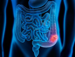 How the third most dangerous cancer is also one of the most preventable