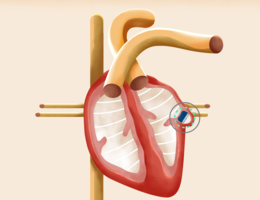 An animated depiction of the Watchman device on the heart. Photo courtesy of Boston Scientific.