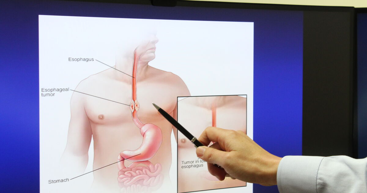 Hot Drinks and Heartburn: Link to Increased Cancer Risk