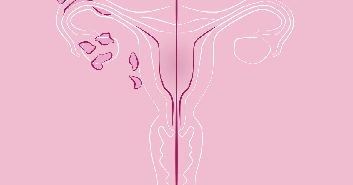 Endometriosis  Loma Linda University Center for Fertility