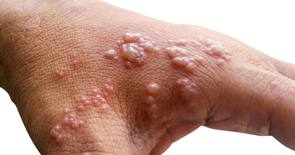 Who Is Most Vulnerable To The Monkeypox Virus?