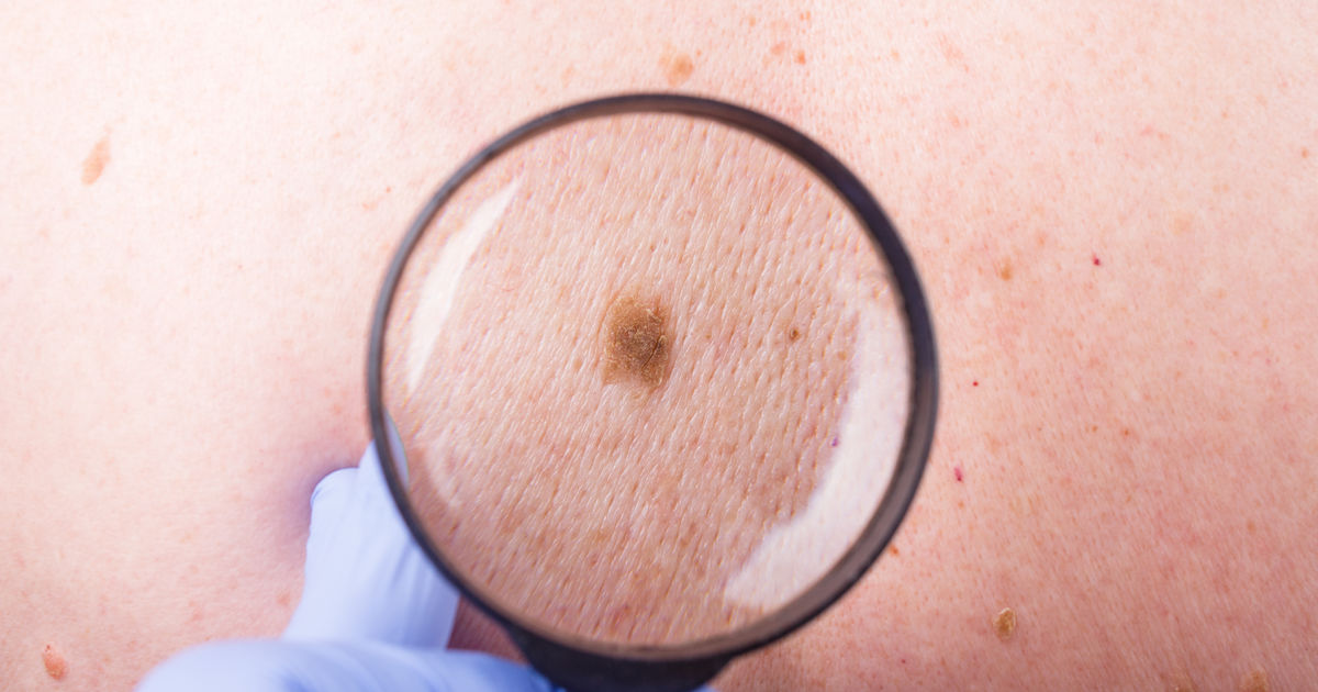 Skin Cancer Pictures, Skin Cancer Images, What Does Skin Cancer Look  Like?